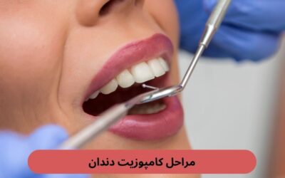 مراحل کامپوزیت دندان