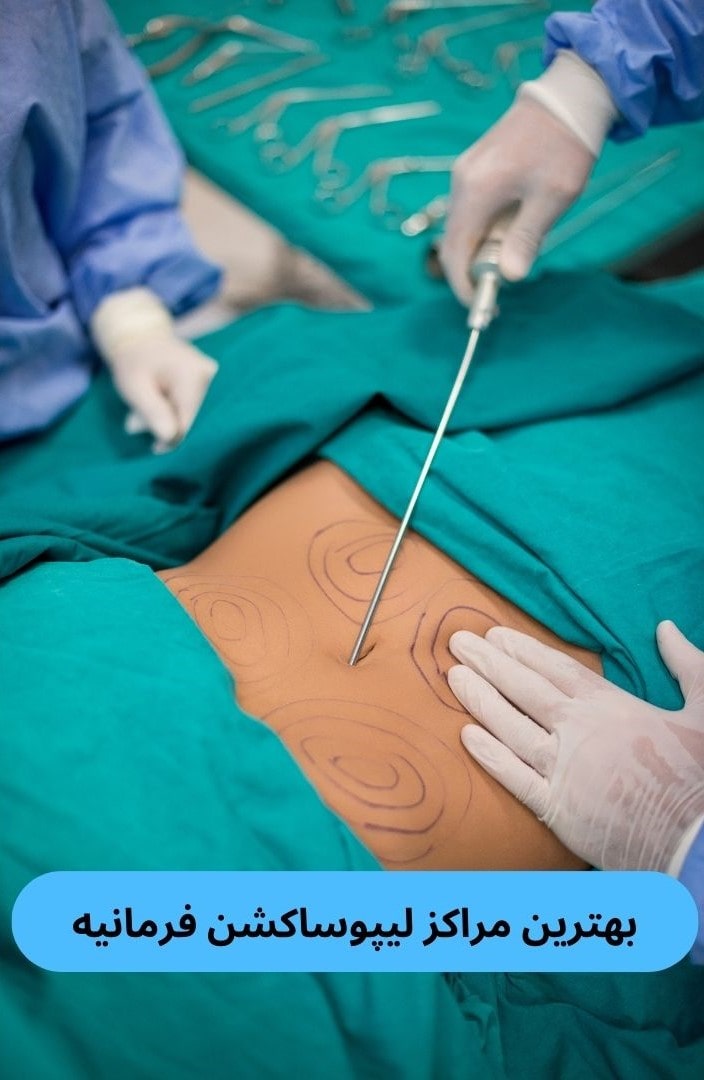 بهترین مراکز لیپوساکشن فرمانیه