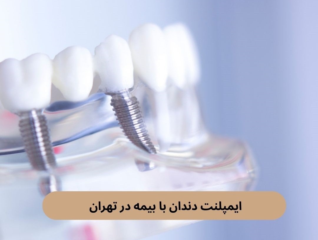 ایمپلنت دندان با بیمه در تهران
