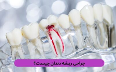 جراحی ریشه دندان چیست؟ مزایا و هر چیزی که باید بدانید