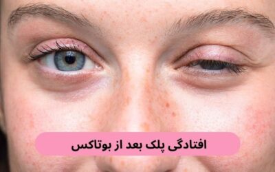 افتادگی پلک بعد از بوتاکس