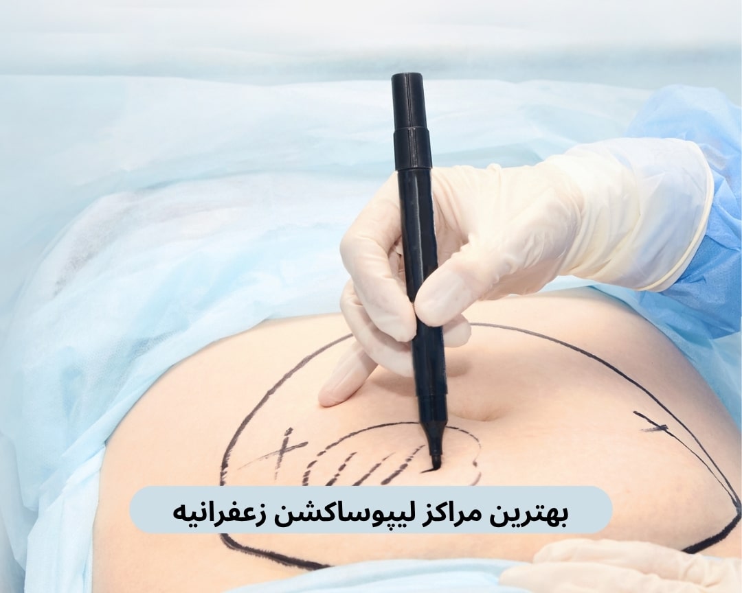 بهترین مراکز لیپوساکشن زعفرانیه