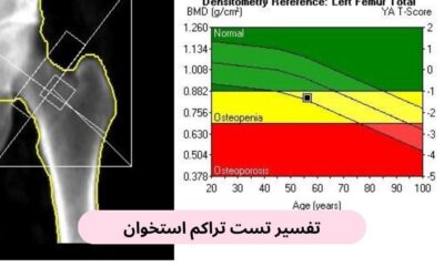 تفسیر تست تراکم استخوان