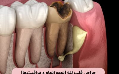 جراحی فلپ لثه [نحوه انجام و مراقبت‌ها]