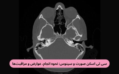 سی تی اسکن صورت و سینوس: نحوه انجام، عوارض و مراقبت‌ها