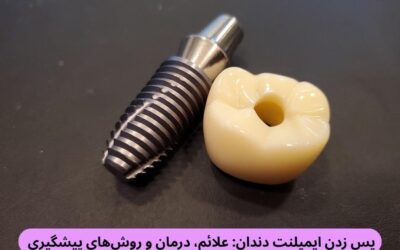 پس زدن ایمپلنت دندان: علائم، درمان و روش‌های پیشگیری 