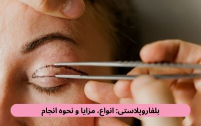 بلفاروپلاستی: انواع، مزایا و نحوه انجام