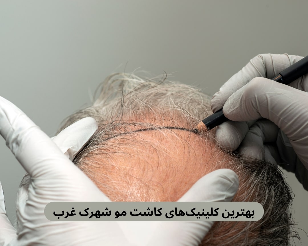 کلینیک کاشت مو شهرک غرب
