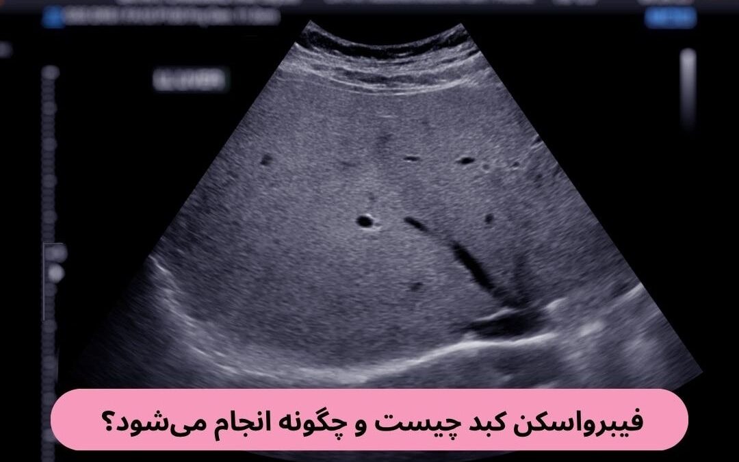 فیبرو اسکن کبد چیست و چگونه انجام می‌شود؟