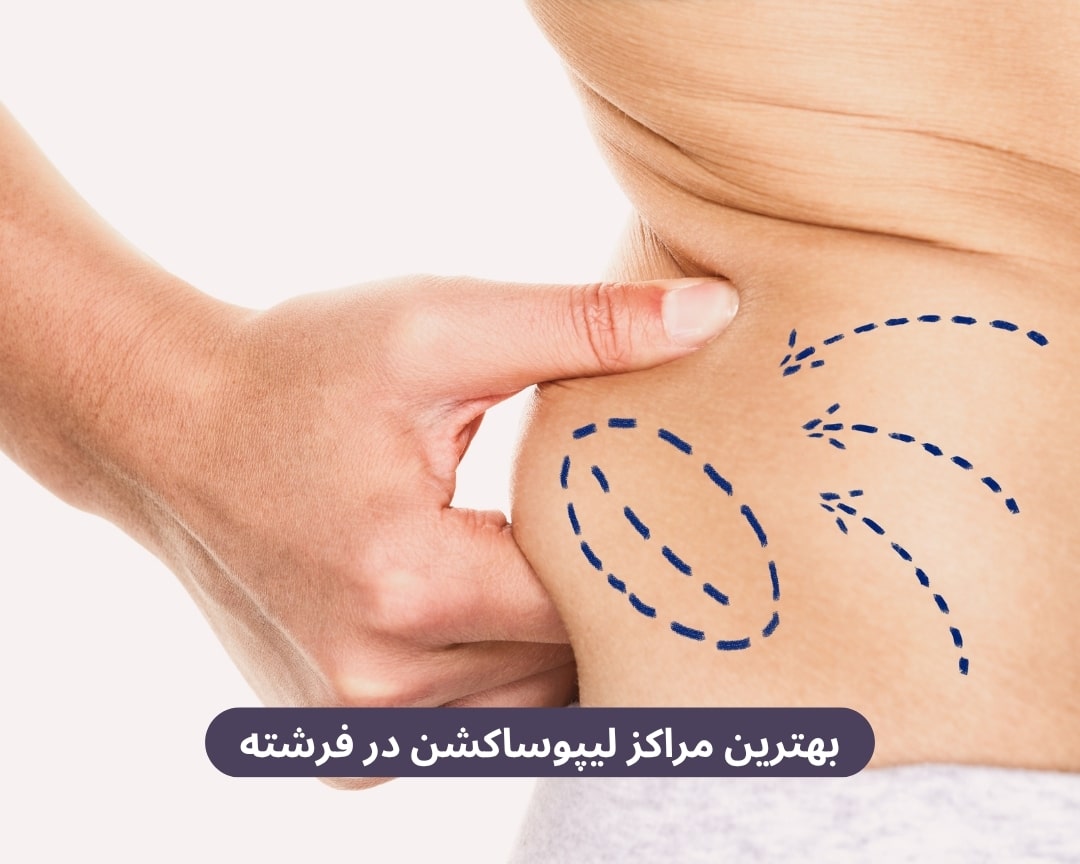 بهترین مراکز لیپوساکشن در فرشته