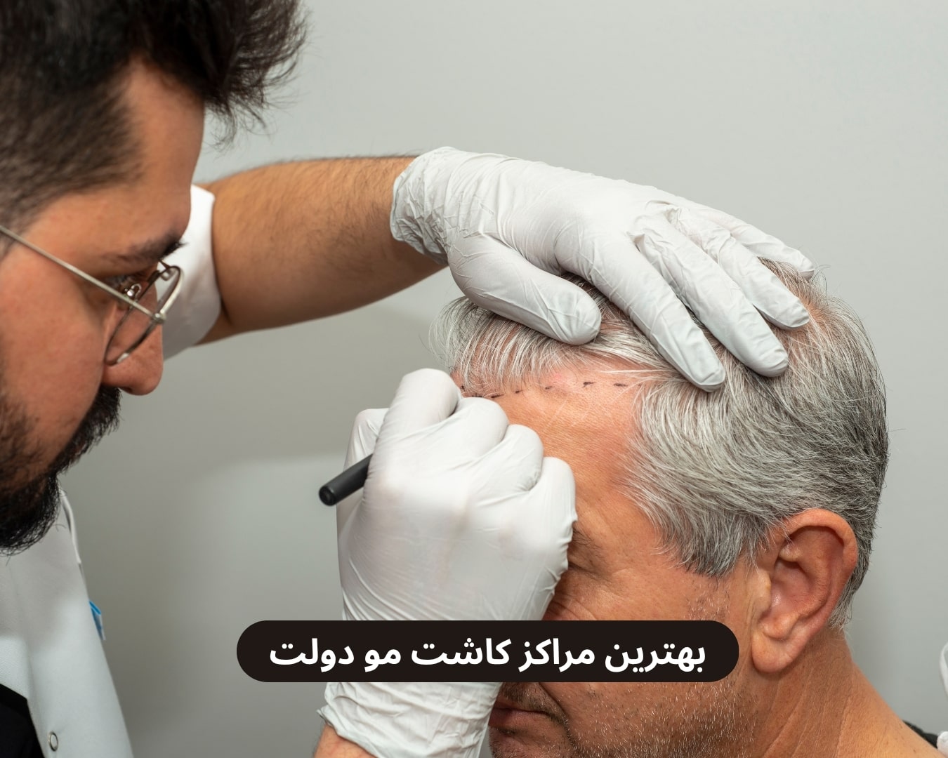 بهترین مراکز کاشت مو دولت