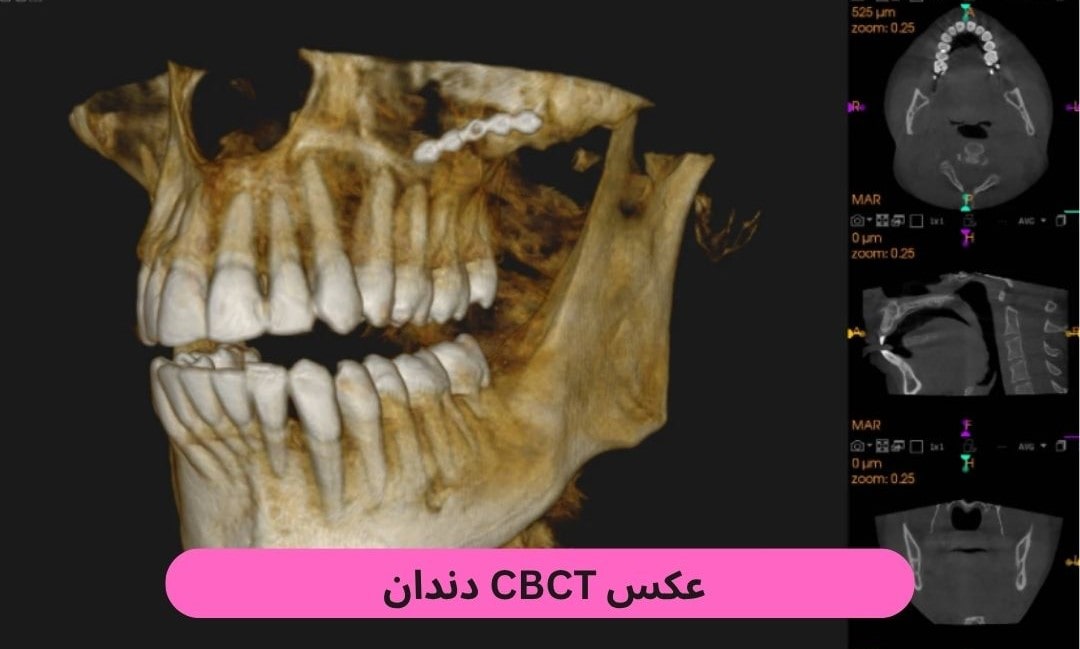 عکس CBCT دندان عکس CBCT دندان