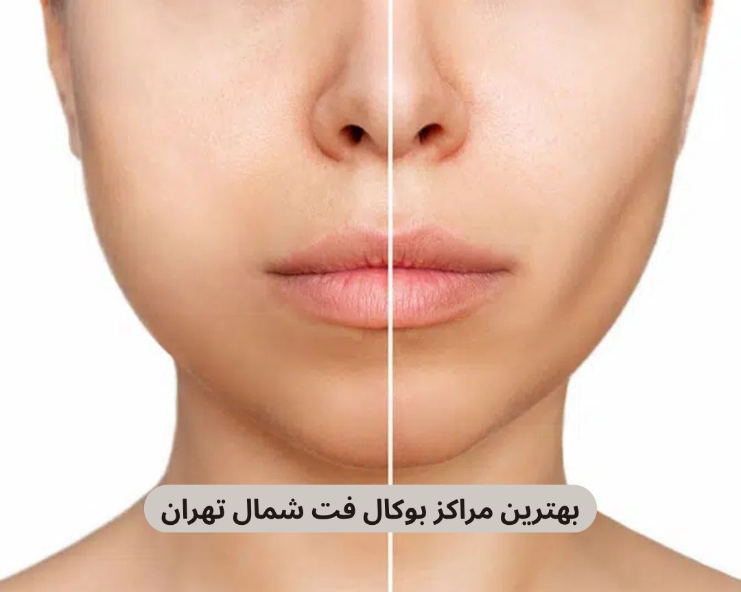 بهترین مراکز بوکال فت شمال تهران