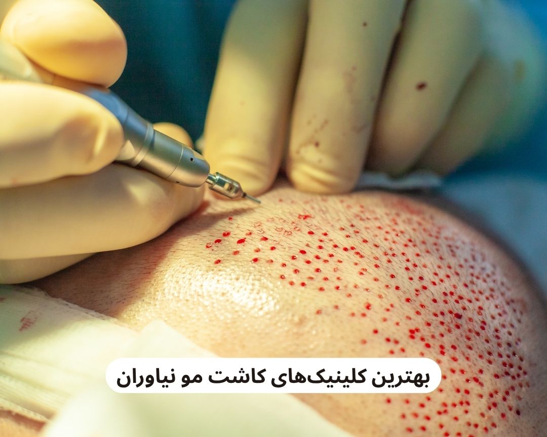 بهترین کلینیک های کاشت مو نیاوران