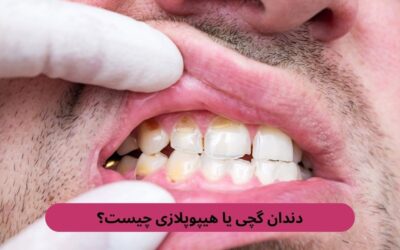 دندان گچی یا هیپوپلازی چیست؟