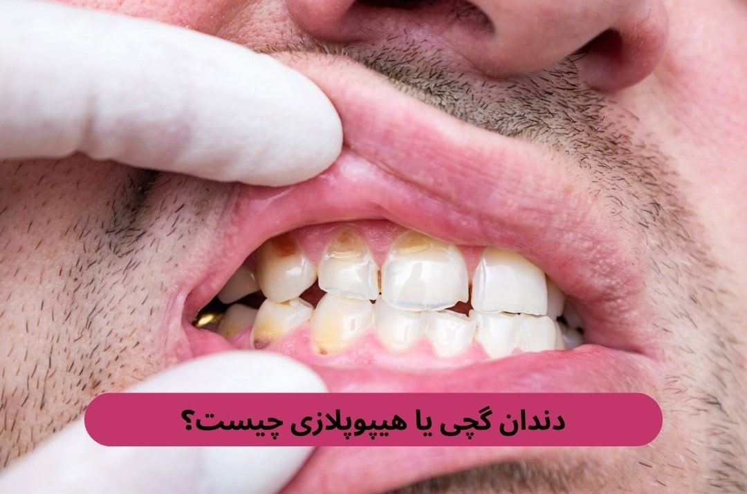 دندان گچی یا هیپوپلازی چیست؟ دندان گچی یا هیپوپلازی چیست؟