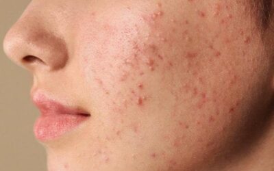 جوش صورت را چگونه از بین ببریم؟ ۴ روش از بین بردن جوش صورت