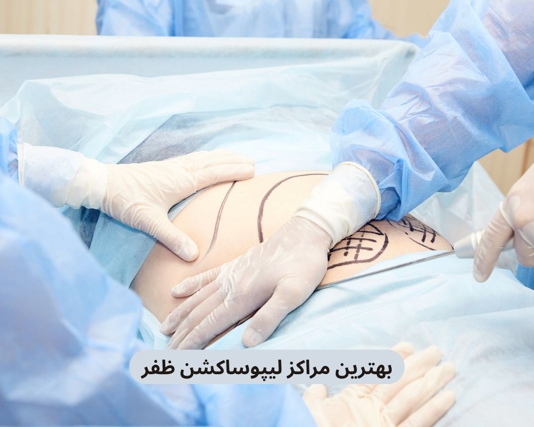 بهترین مراکز لیپوساکشن ظفر