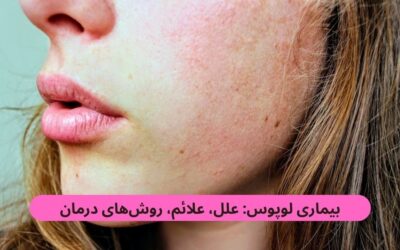 بیماری لوپوس: علل، علائم، روشهای درمان