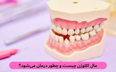 مال اکلوژن چیست و چطور درمان میشود؟