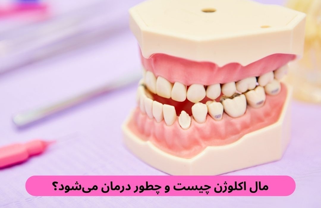 مال اکلوژن چیست و چطور درمان می_شود؟ مال اکلوژن چیست و چطور درمان می_شود؟