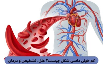 کم خونی داسی شکل چیست؟ علل، تشخیص و درمان