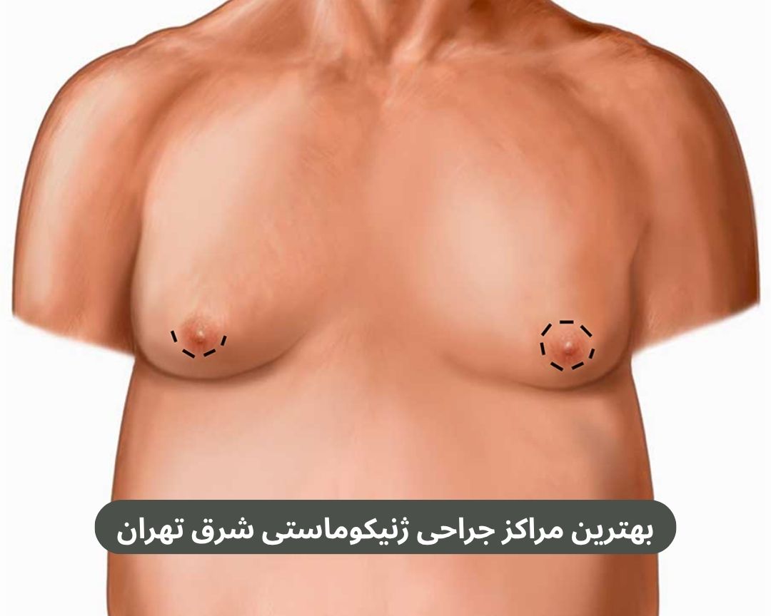 بهترین مراکز جراحی ژنیکوماستی شرق تهران
