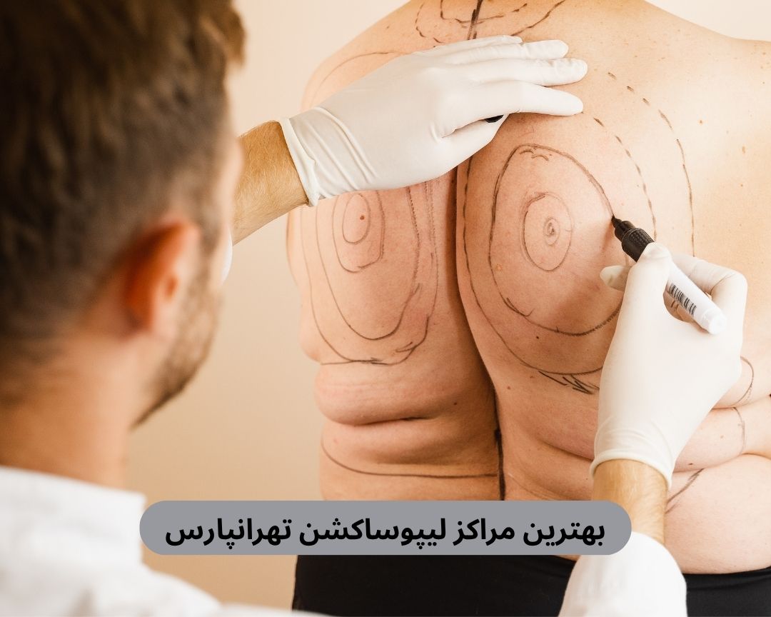 بهترین مراکز لیپوساکشن تهرانپارس