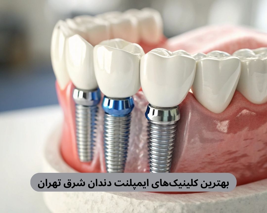 بهترین کلینیک های ایمپلنت دندان شرق تهران