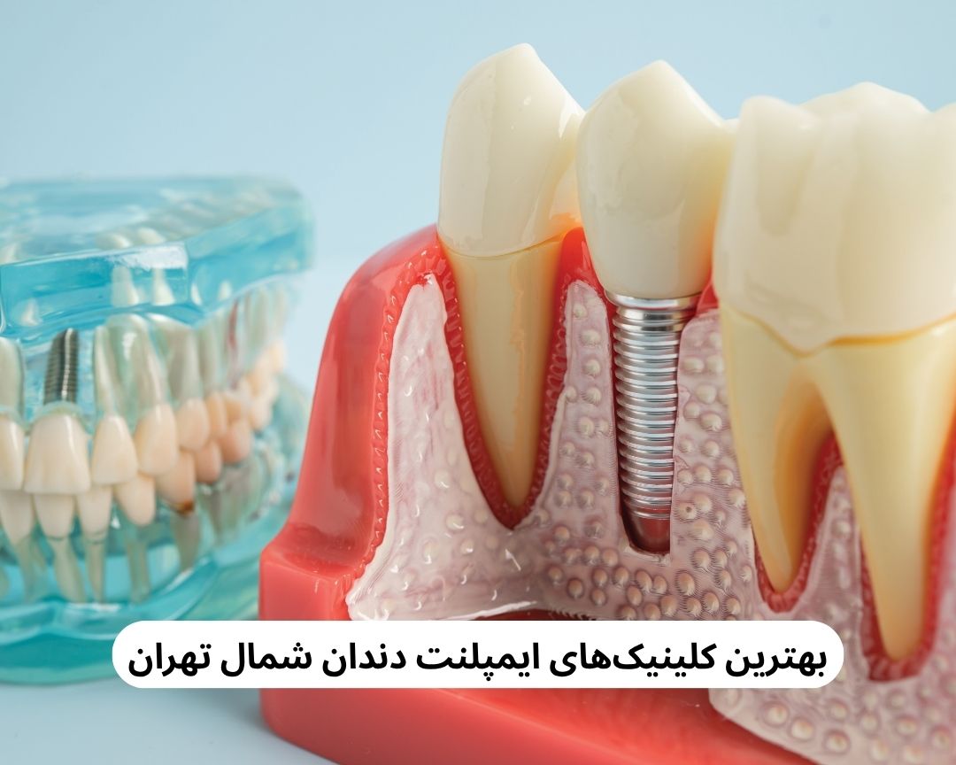 بهترین کلینیک های ایمپلنت دندان شمال تهران