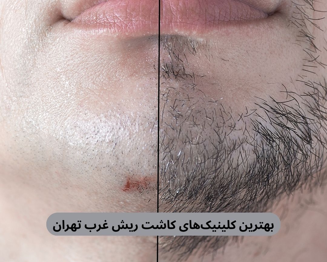 بهترین کلینیک های کاشت ریش غرب تهران