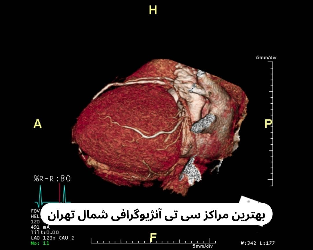 بهترین مراکز سی تی آنژیوگرافی شمال تهران