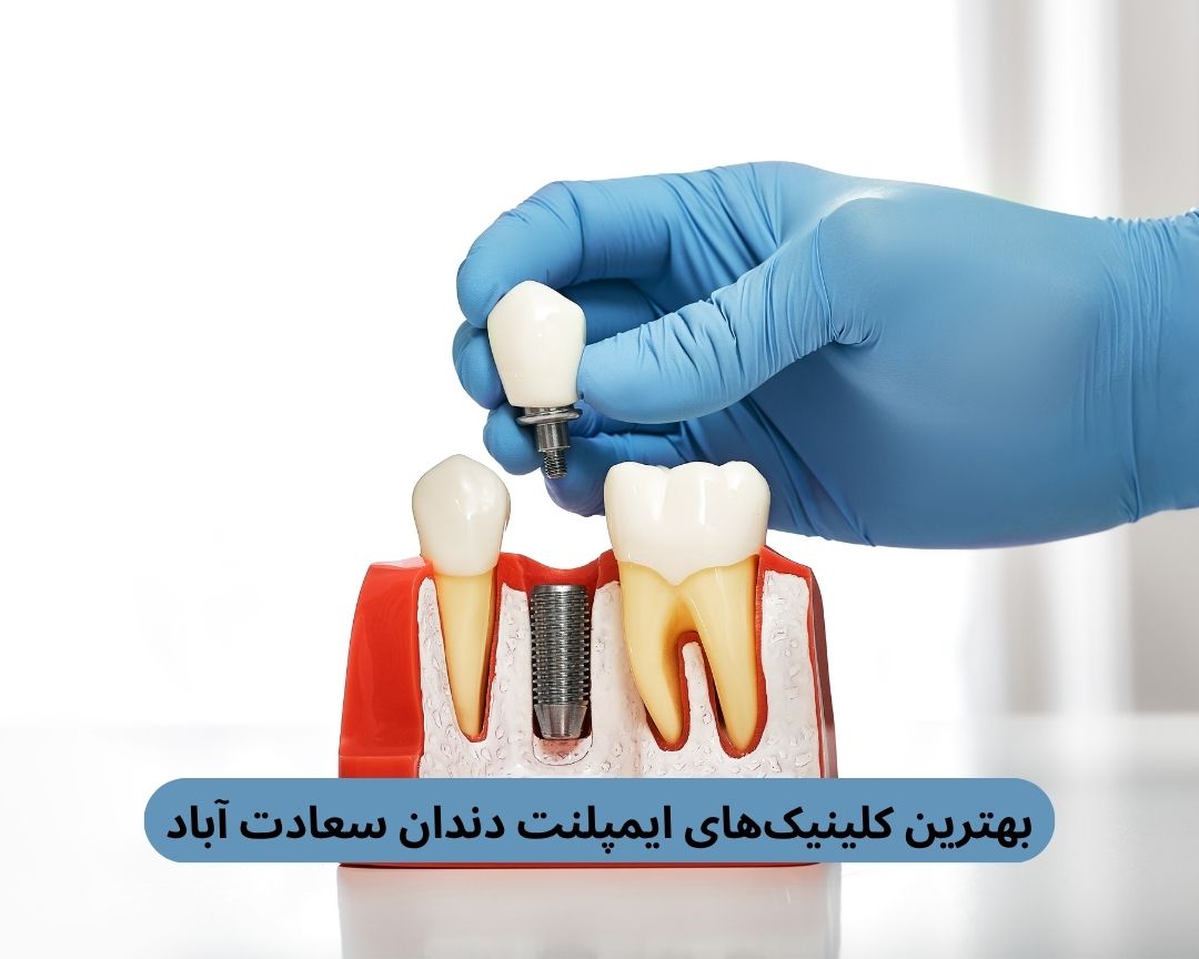 بهترین کلینیک های ایمپلنت دندان سعادت آباد
