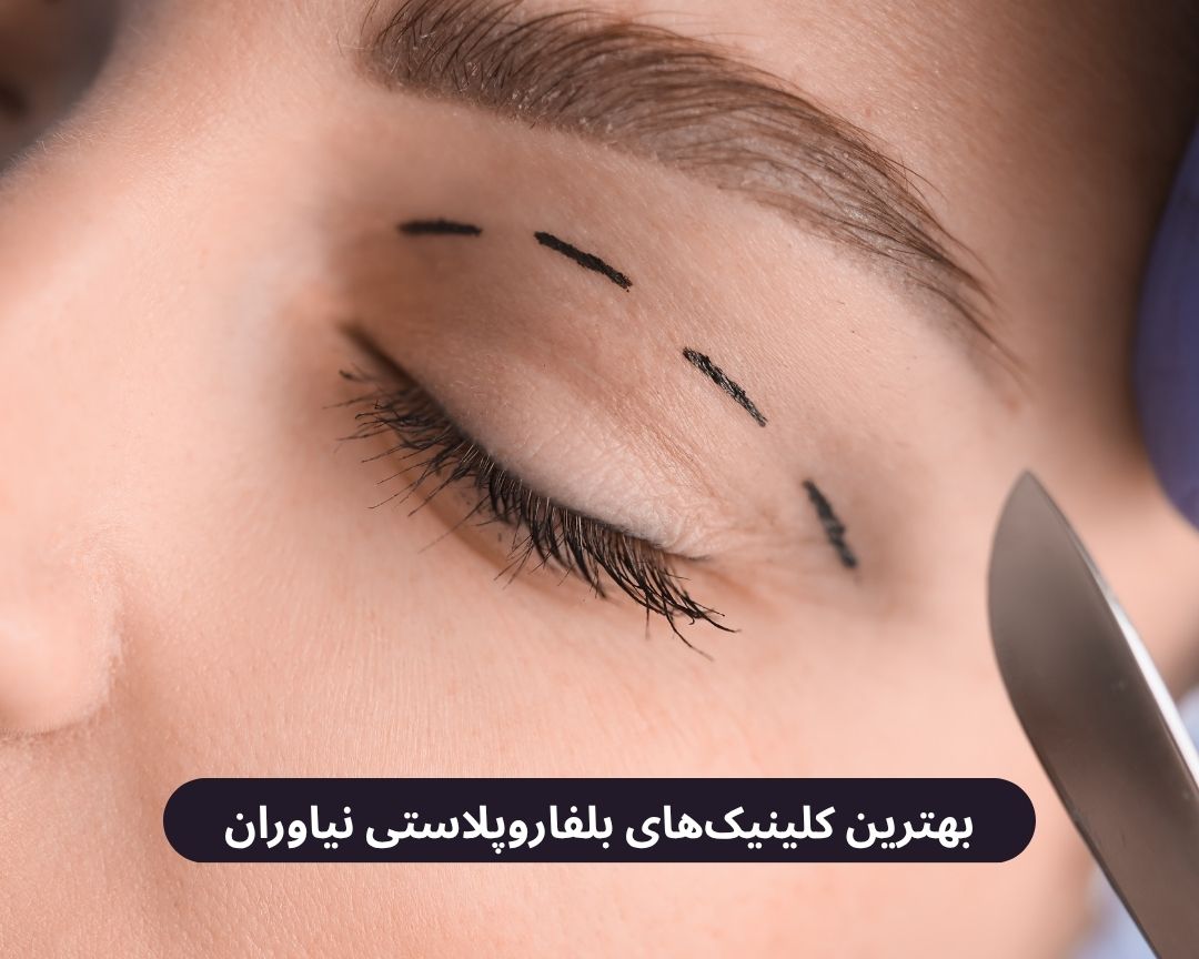 بهترین کلینیک های بلفاروپلاستی نیاوران