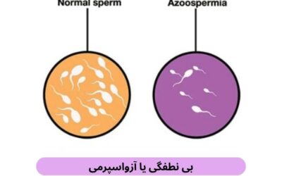 بی نطفگی یا آزواسپرمی