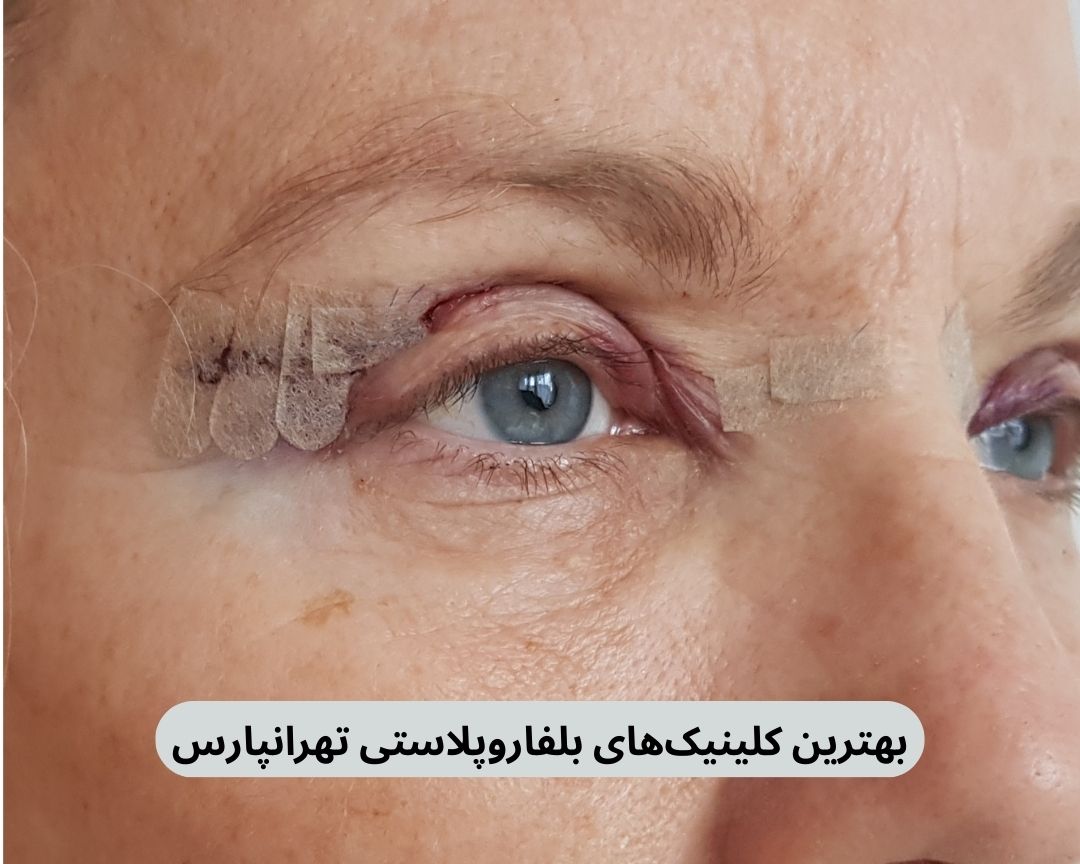 بهترین کلینیک بلفاروپلاستی تهرانپارس