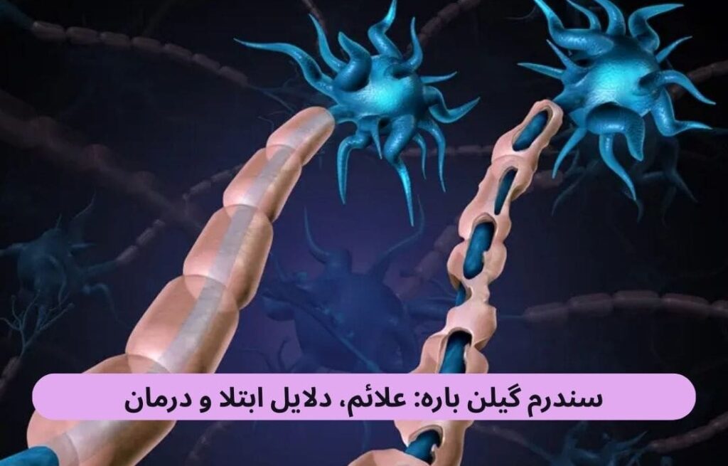 سندرم گیلنباره یک نوع اختلال عصبی یا نوروپاتی محیطی است که در آن سیستم ایمنی بدن بهاشتباه به اعصاب حملهور میشود.