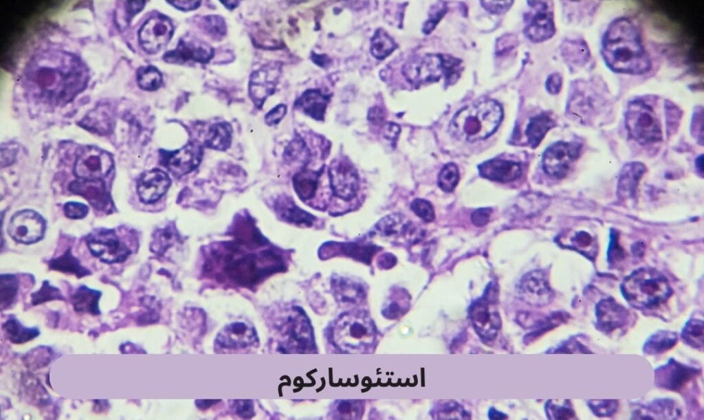 استئوسارکوم یا سارکوم استئوپلاستیک شایعترین نوع سرطان استخوان اولیه است که حدود ۲۰ درصد از کل تومورهای بدخیم استخوانی را شامل میشود.