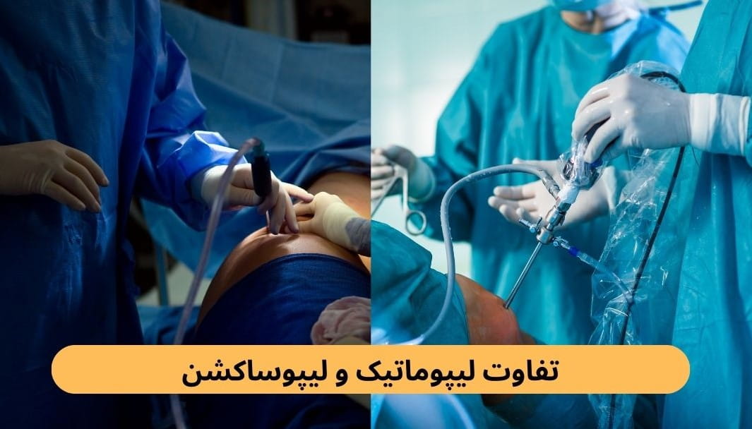 لیپوساکشن و لیپوماتیک دو عمل پرطرفدار در حوزه جراحی‌های لاغری و پیکرتراشی هستند که هدف نهایی هر دو، حذف بافت‌های چربی ناخواسته و بهبود فرم شکم و بدن است.