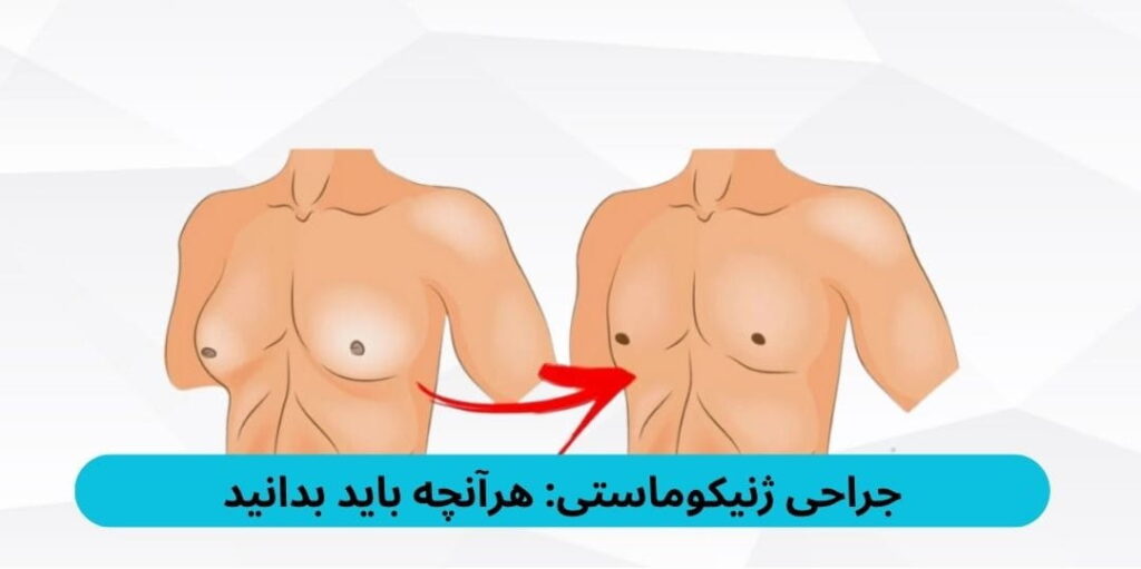 در این مقاله انواع عمل ژنیکوماستی، کاندیدای مناسب، شیوه عمل و مراقبتهای پس از آن را بهشکل کامل بررسی میکنیم.