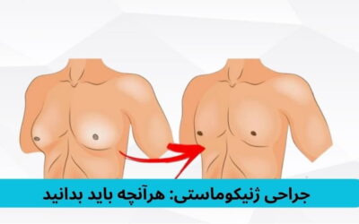 جراحی ژنیکوماستی: هرآنچه باید بدانید
