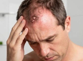 قارچ پوست سر چیست؟ بررسی علل، علائم و راه‌های پیشگیری