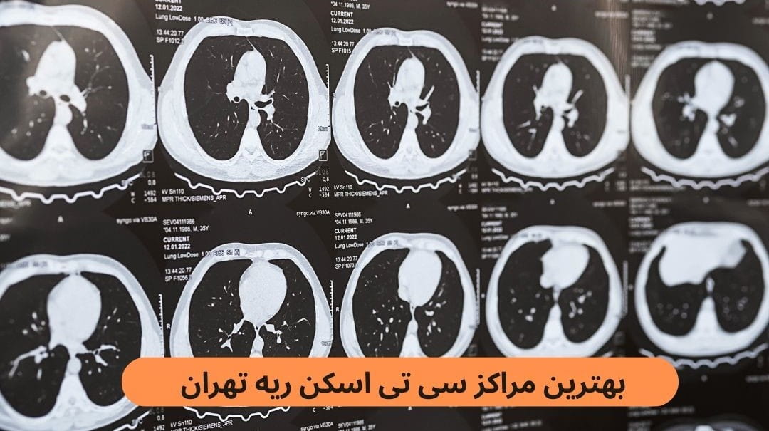 برای پیدا کردن بهترین مرکز سی تی اسکن ریه تهران باید به پارامترهایی از قبیل رضایت مراجعین، به روز بودن دستگاه‌ها و غیره توجه کنید.
