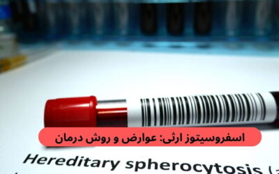 اسفروسیتوز ارثی: عوارض و روش درمان