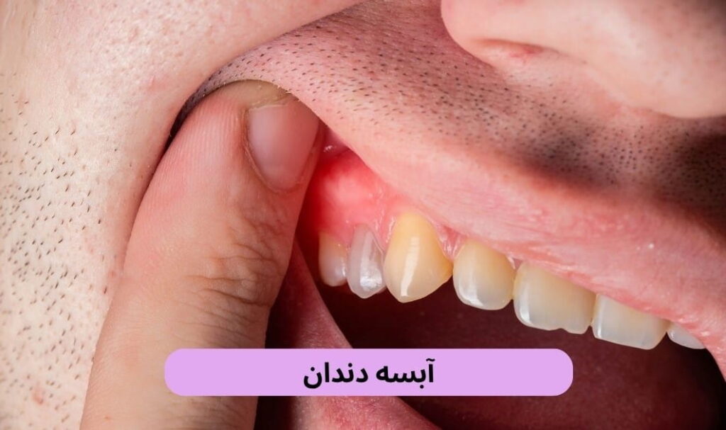 آبسه دندان، حفره یا کیسهای حاوی چرک است که بر اثر عفونت باکتریایی در داخل دندان، انتهای ریشه یا بافت لثه تشکیل میشود.