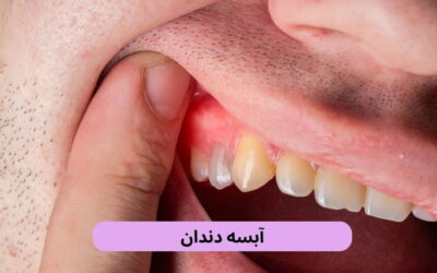 آبسه دندان