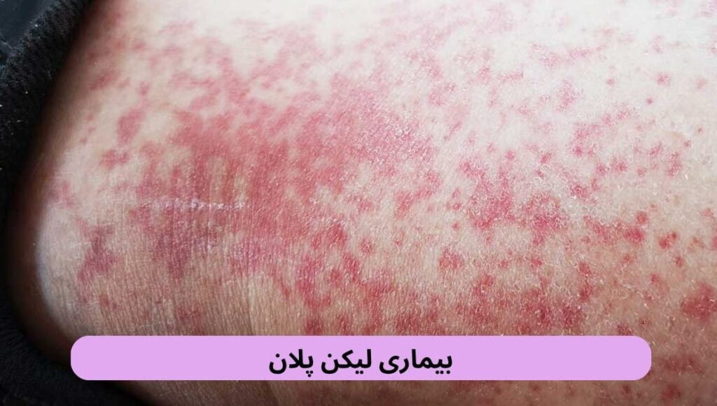لیکن پلان بیماری التهابی است که پوست، مخاط دهان و ناحیه تناسلی، مو و ناخنها را درگیر میکند. علت اصلی آن واکنش غیرطبیعی سیستم ایمنی است.