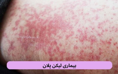 بیماری لیکن پلان