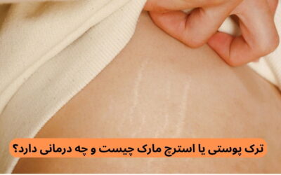 ترک پوستی یا استرچ مارک چیست و چه درمانی دارد؟