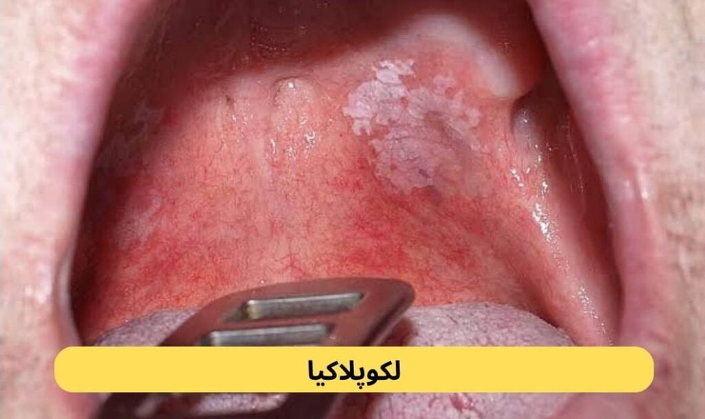 لکوپلاکیا نوعی تغییر در بافت داخل دهان است که معمولاً به شکل لکه یا پلاک سفید دیده میشود. این ضایعات دهان و لثه بهراحتی از بین نمیروند.